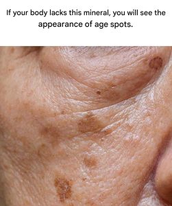 A deficiency of this mineral increases the risk of age spots.