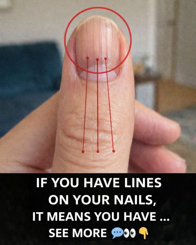 Lines on Your Fingernails: What They Might Reveal About Your Health
